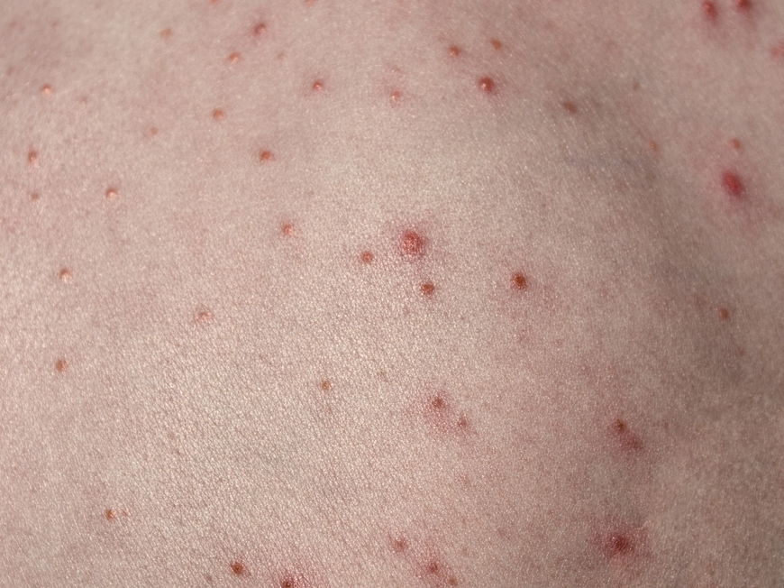 Haut mit roten Pusteln darauf