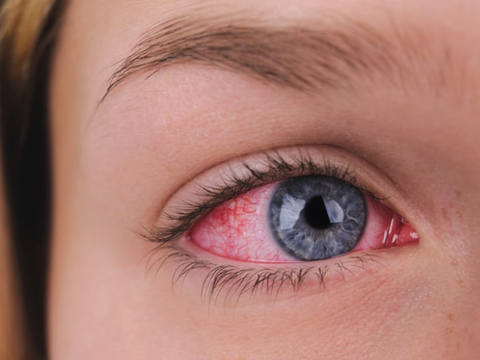 Rote Augen nach dem Schlafen: Normal oder Notfall?