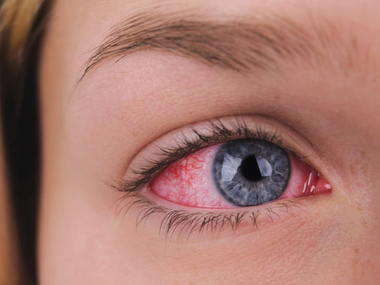 Frau mit geröteten Augen