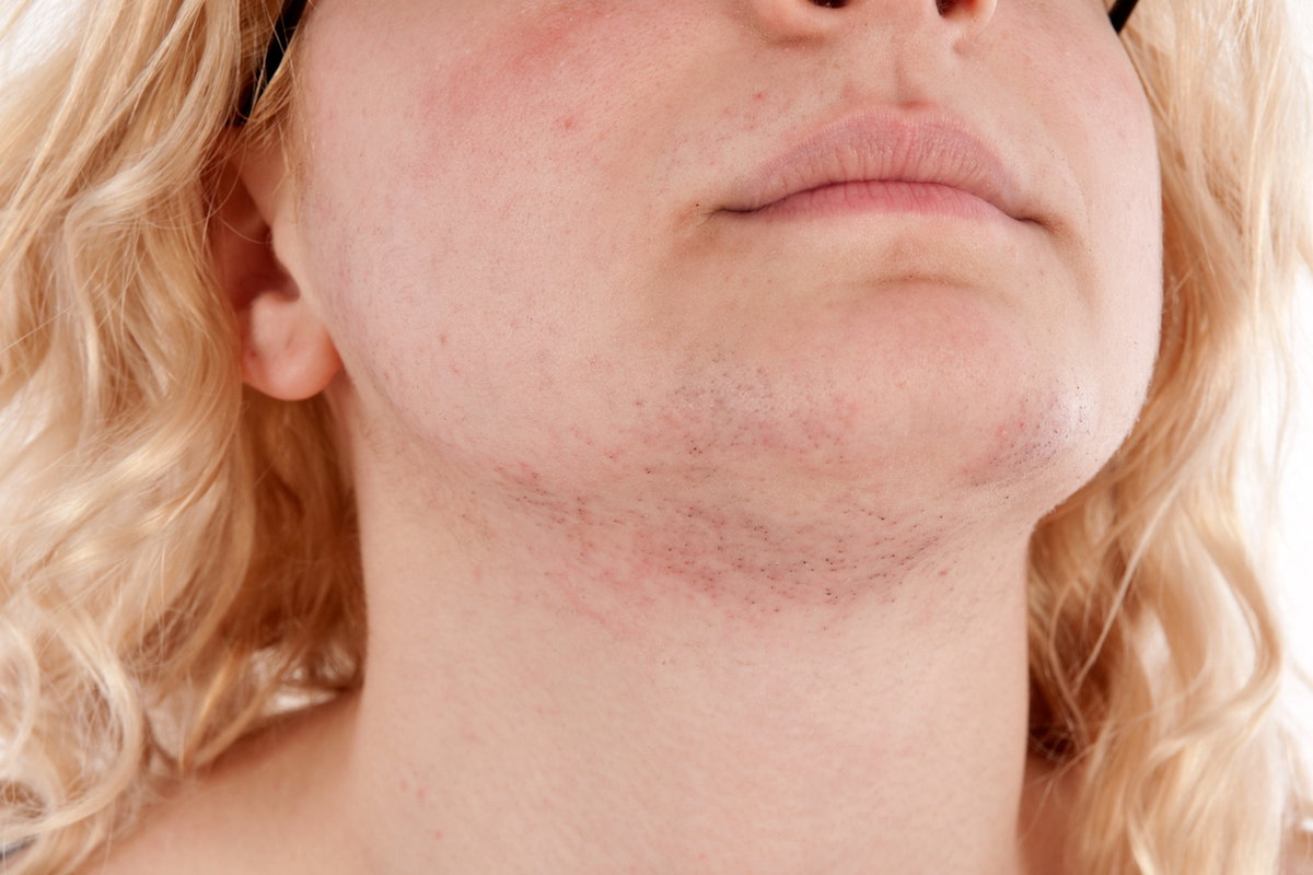 Junge Frau mit Testosteronüberschuss und Kinnbart.