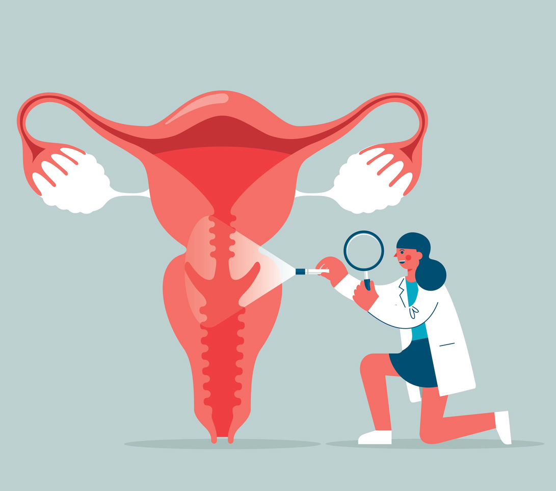 Bei einer Endometriose siedelt sich Gewebe außerhalb der Gebärmutterhöhle ansiedelt.