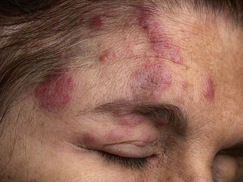 Gesichtsrose: So erkennen Sie Gürtelrose im Gesicht