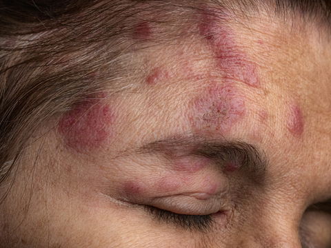 Gesichtsrose: So erkennen Sie Gürtelrose im Gesicht