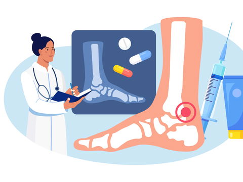 Rheuma: Symptome und Behandlung bei rheumatoider Arthritis
