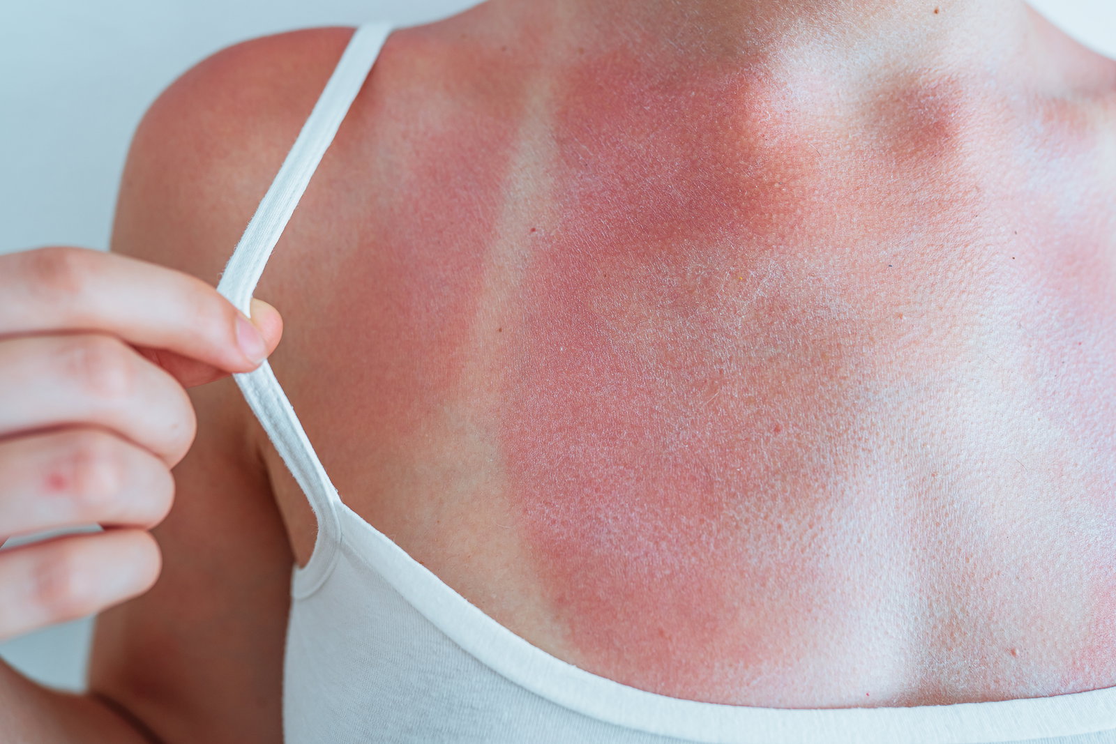  Juckreiz nach Sonnenbrand: Diese Tipps sorgen für Linderung