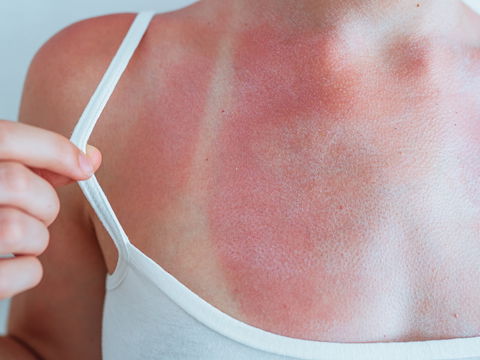  Juckreiz nach Sonnenbrand: Diese Tipps sorgen für Linderung