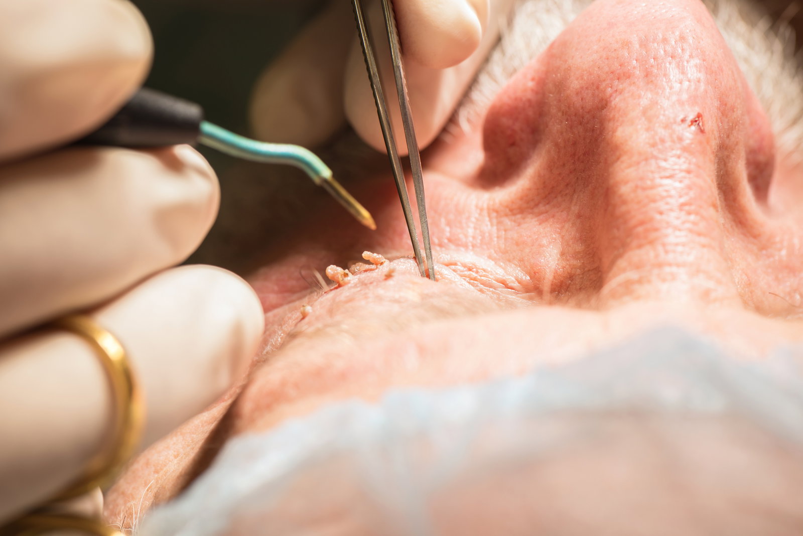 Pinselwarze entfernen: Ein Fall für den Dermatologen