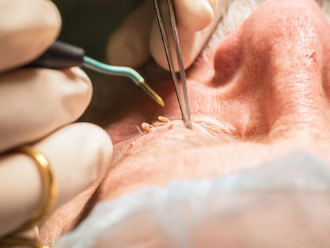 Pinselwarze entfernen: Ein Fall für den Dermatologen