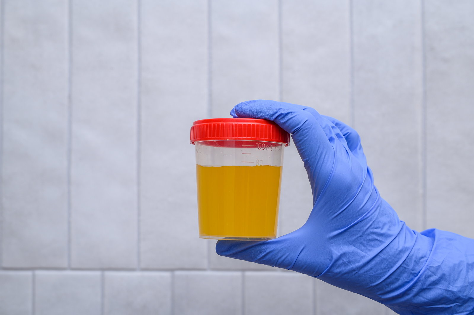 Dunkler Urin – was die Farbe bedeutet und über Ihre Gesundheit aussagt