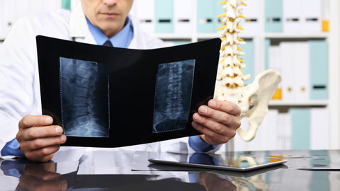 Künstliche Bandscheibe: Was Sie zur Prothese wissen müssen