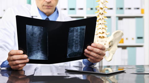 Künstliche Bandscheibe: Was Sie zur Prothese wissen müssen