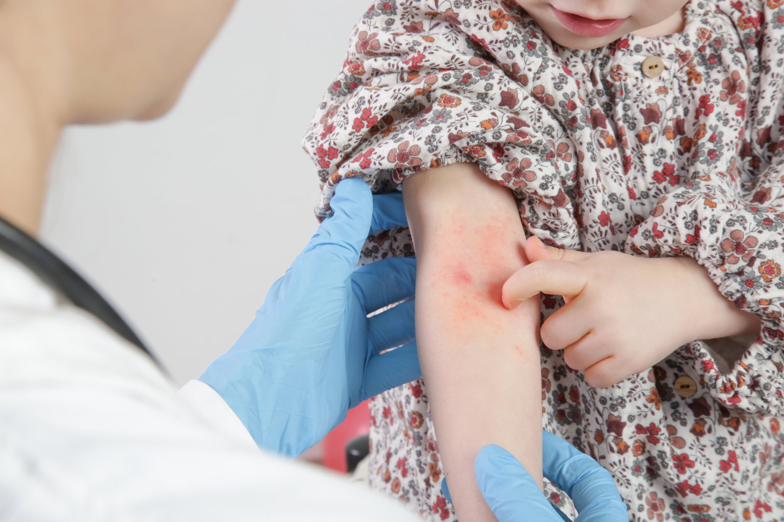  Neurodermitis bei Kindern: Was den Juckreiz lindert