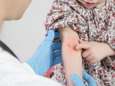 Neurodermitis bei Kindern: Was den Juckreiz lindert