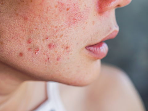 Spätakne: Gründe für unreine Haut im Erwachsenenalter