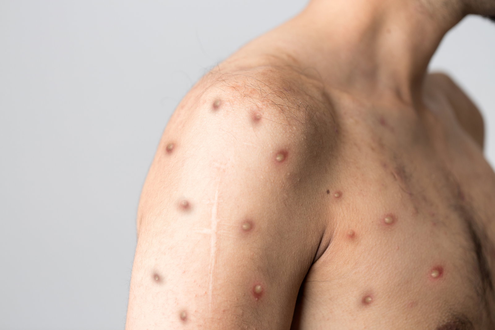 Mpox in Deutschland: Schule in NRW vorsorglich geschlossen