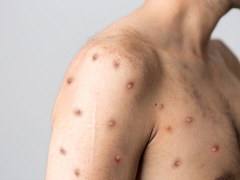 Mpox in Deutschland: Schule in NRW vorsorglich geschlossen