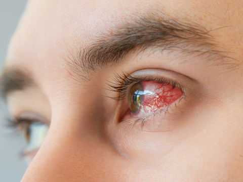 Ader im Auge geplatzt: So gefährlich ist die Blutung wirklich