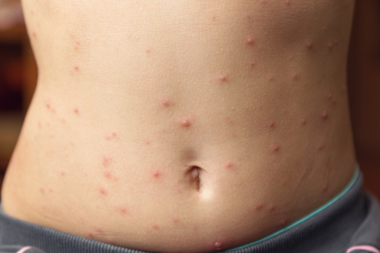 Rote Flecken am Bauch: Sind die winzigen roten Punkte gefährlich?