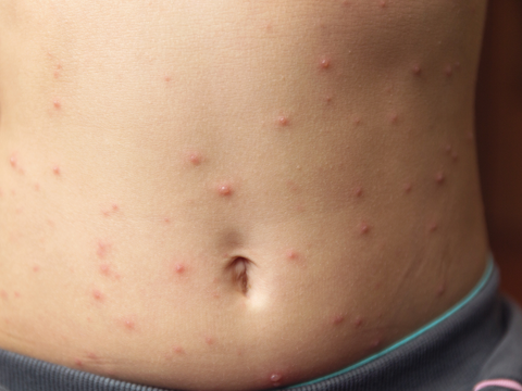 Rote Flecken am Bauch: Sind die winzigen roten Punkte gefährlich?