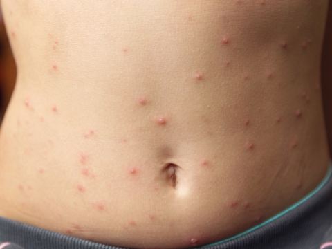 Rote Flecken am Bauch: Sind die winzigen roten Punkte gefährlich?