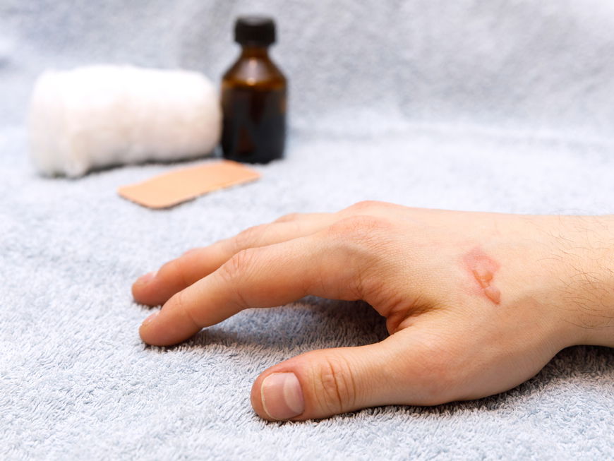 Hand mit Brandblase