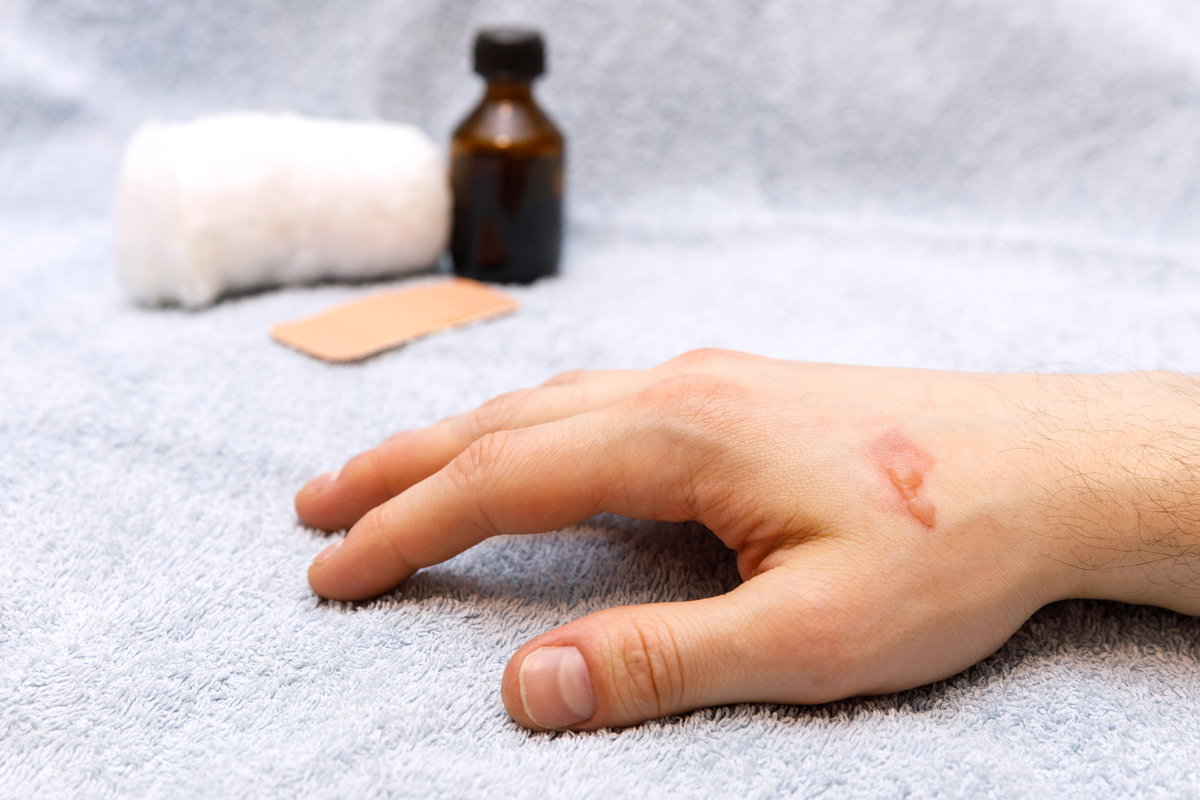 Hand mit Brandblase