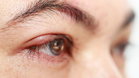 Augenlid innen rot? Hier kommen die 5 besten Tipps und Hausmittel