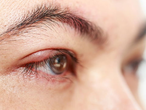 Augenlid innen rot? Hier kommen die 5 besten Tipps und Hausmittel