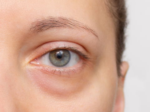 Gelbe Augenringe: Was dahinter stecken kann