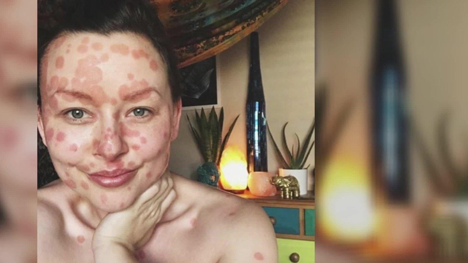 Psoriasis: Diese Frau zeigt, dass niemand sich für Schuppenflechte schämen sollte