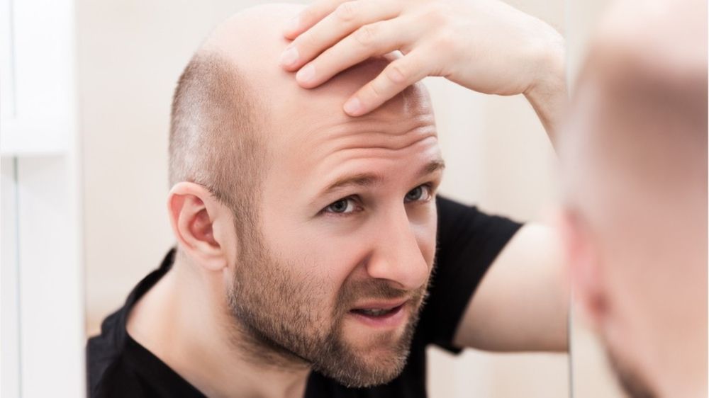 Neue Studie: Zu viel Arbeit begünstigt Haarausfall bei Männern