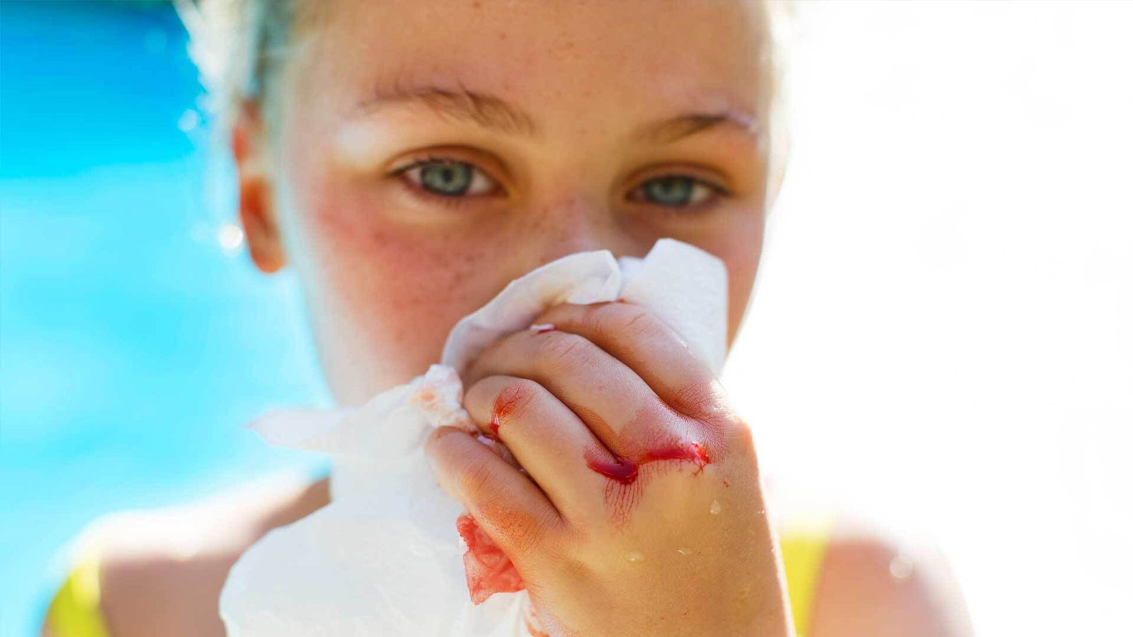 Nasenbluten bei Kindern: Was Eltern wissen müssen!