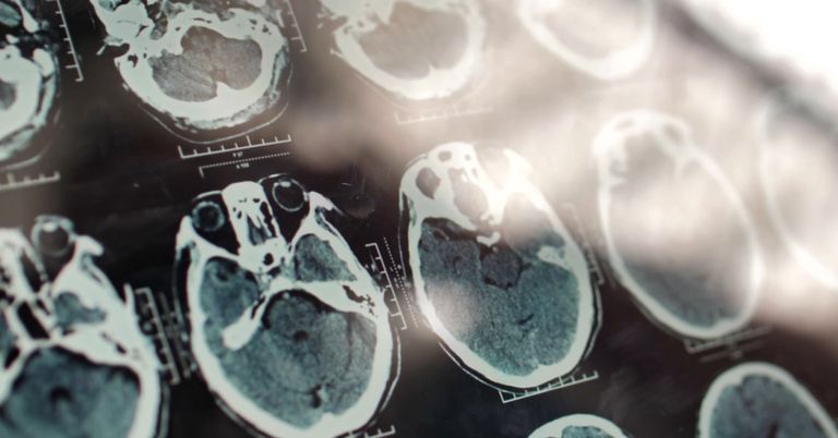 Um 35 Prozent: Dieser neue Wirkstoff verlangsamt Alzheimer