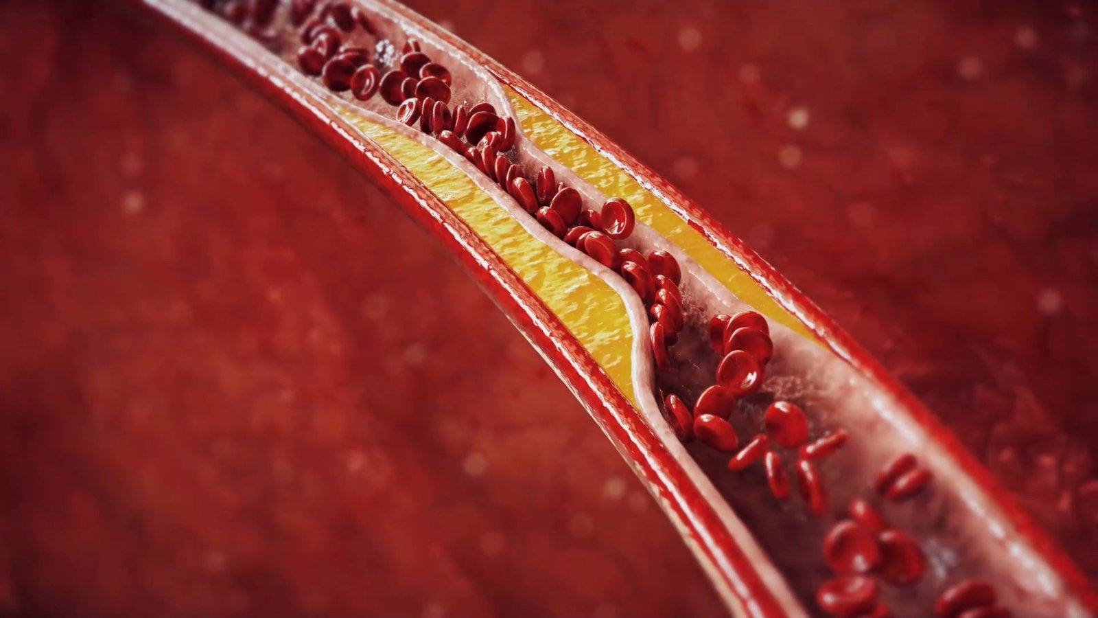 Arteriosklerose: So macht sich eine Arterienverengung bemerkbar