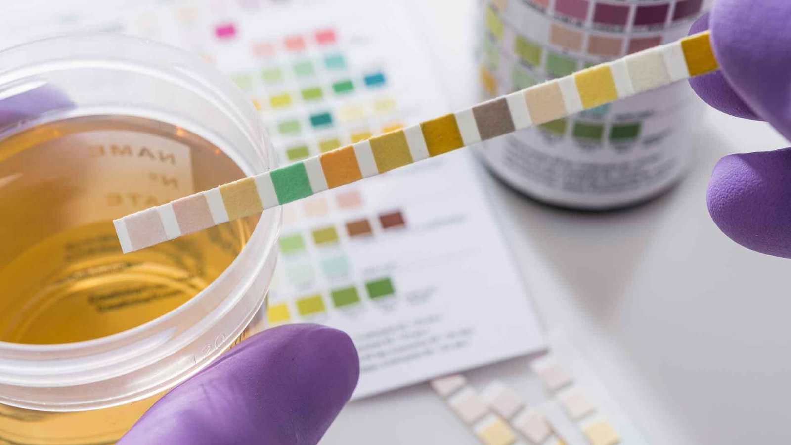 Was steckt hinter Blut im Urin?