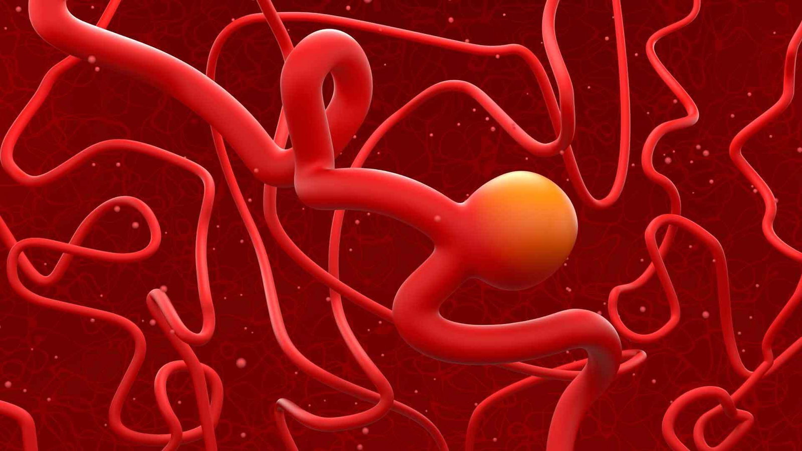 Aneurysma im Kopf: Diese Symptome sind Warnzeichen