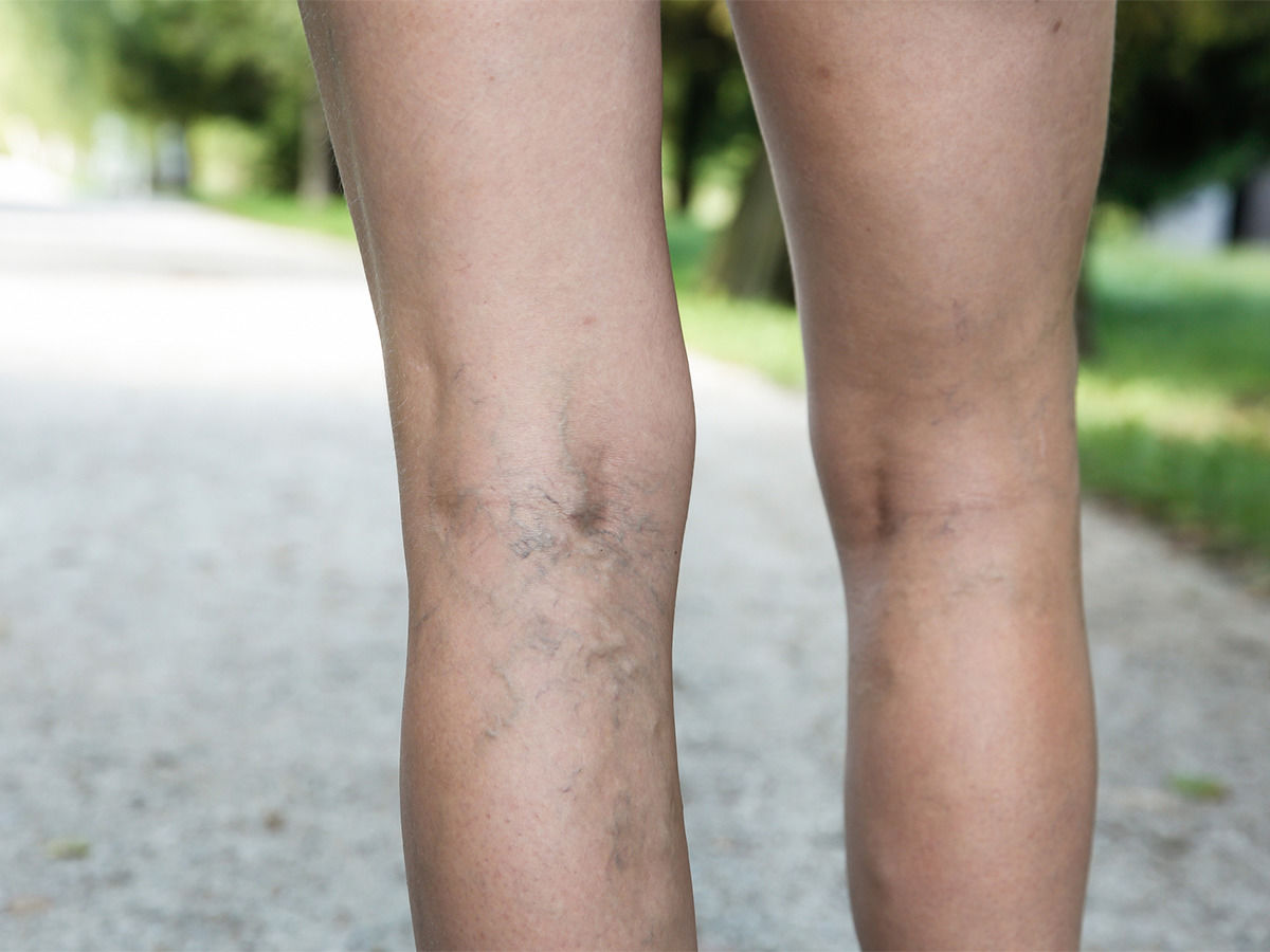 Thrombose in den Beinen
