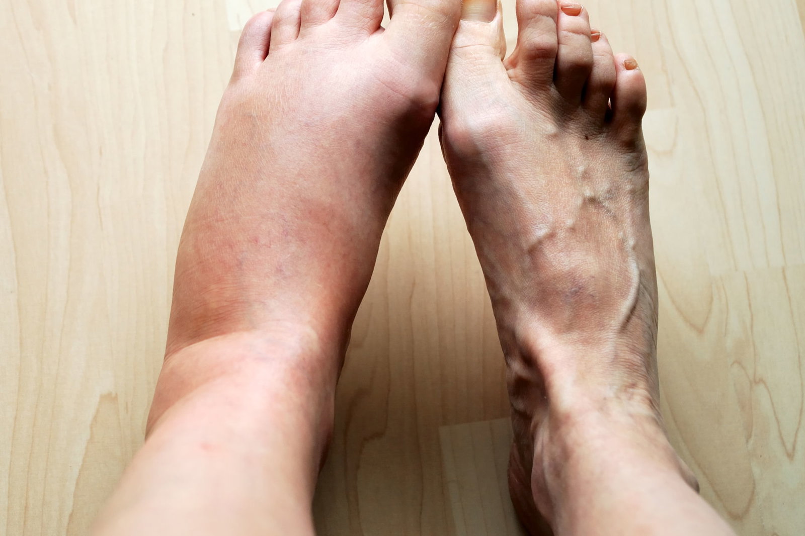 Lymphödem: Symptome & Behandlung