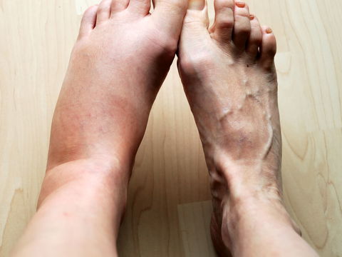 Lymphödem: Symptome & Behandlung