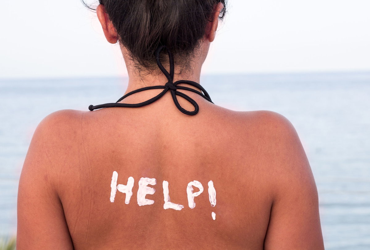 Frau mit Sonnenbrand und Sonnencreme auf dem Rücken