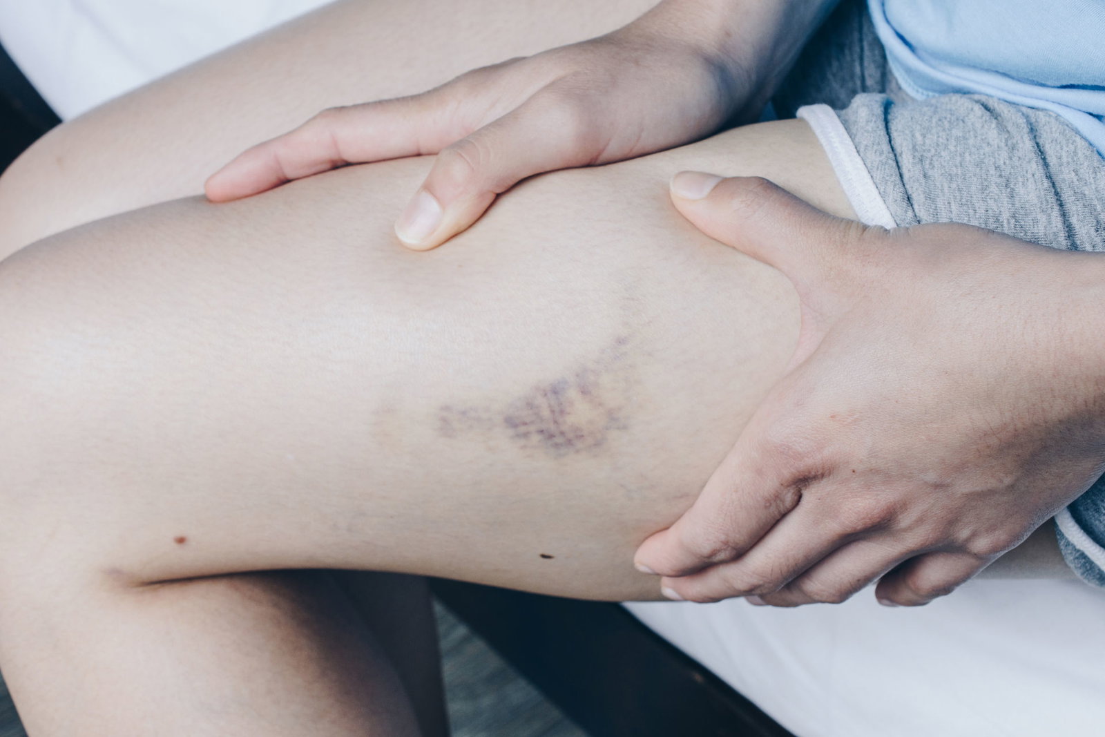 Darum bekommen Frauen leichter blaue Flecken