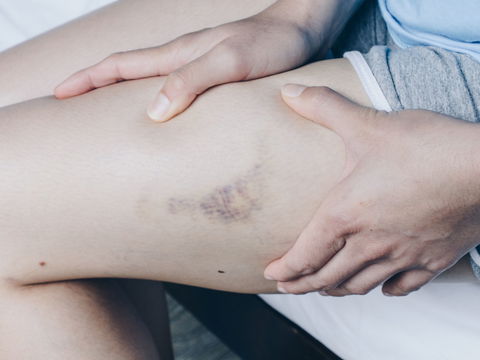 Darum bekommen Frauen leichter blaue Flecken