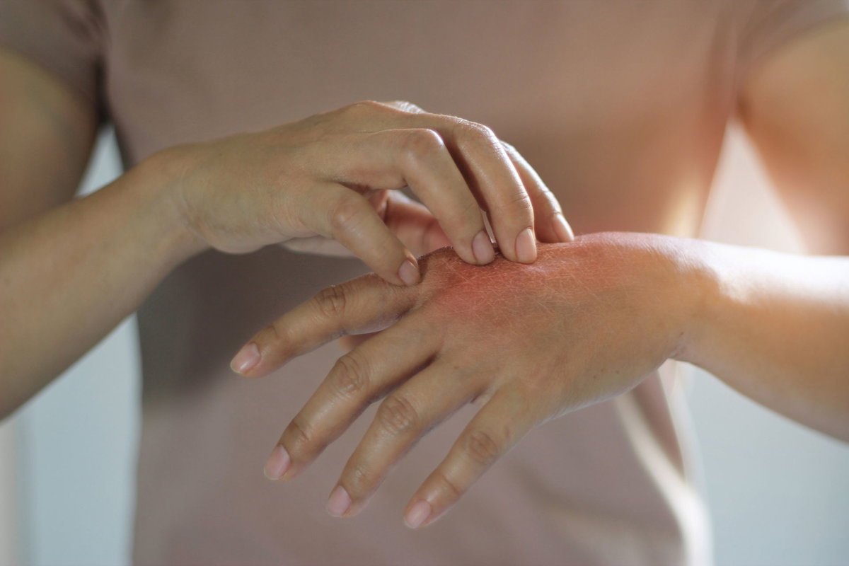 Frau kratzt sich an geröteter Hand, Neurodermitis